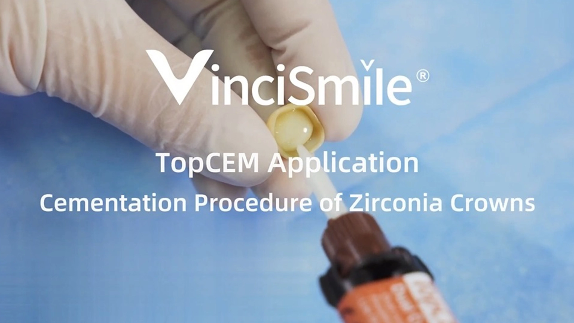 Vincismile topcem phục hồi gián tiếp-Xi Măng vương miện Zirconia